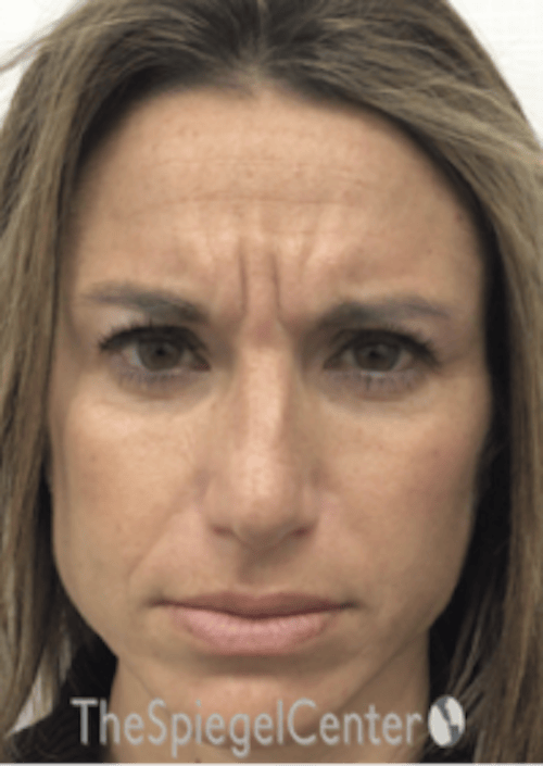 Botox / Dysport / Jeuveau / Xeomin Before & After Gallery - Patient 489094 - Image 1