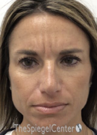Botox / Dysport / Jeuveau / Xeomin Before & After Gallery - Patient 489094 - Image 2