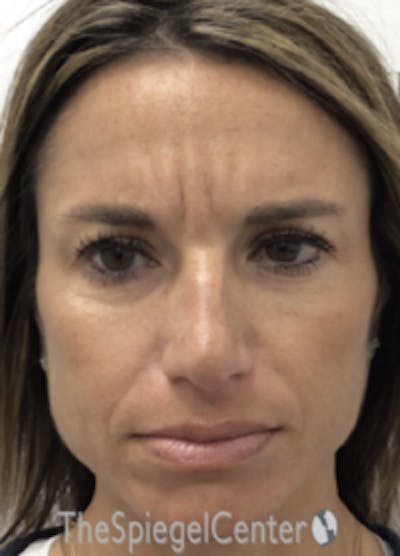 Botox / Dysport / Jeuveau / Xeomin Before & After Gallery - Patient 489094 - Image 2