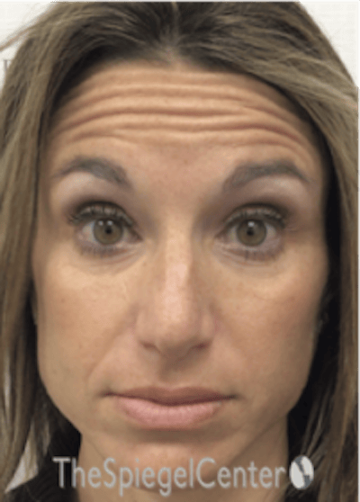 Botox / Dysport / Jeuveau / Xeomin Before & After Gallery - Patient 489094 - Image 3