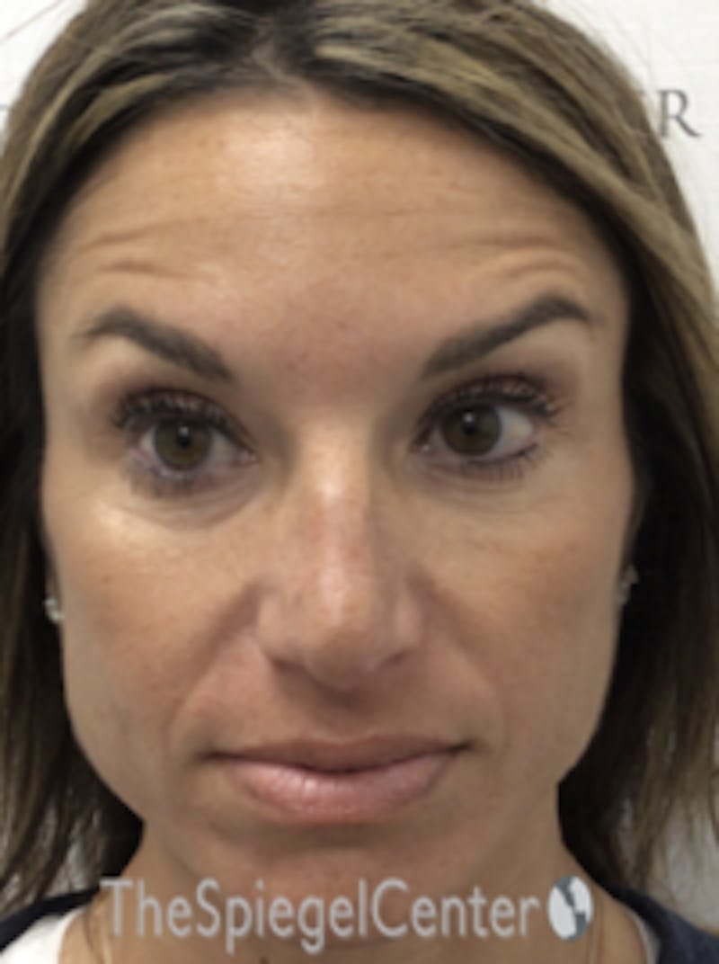 Botox / Dysport / Jeuveau / Xeomin Before & After Gallery - Patient 489094 - Image 4