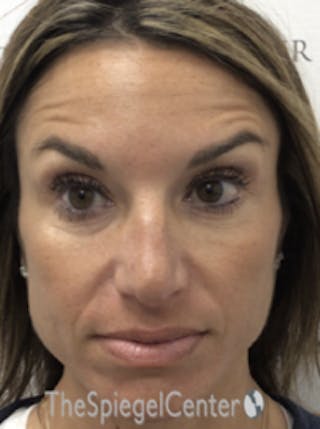Botox / Dysport / Jeuveau / Xeomin Before & After Gallery - Patient 489094 - Image 4