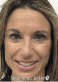 Botox / Dysport / Jeuveau / Xeomin Before & After Gallery - Patient 489094 - Image 5