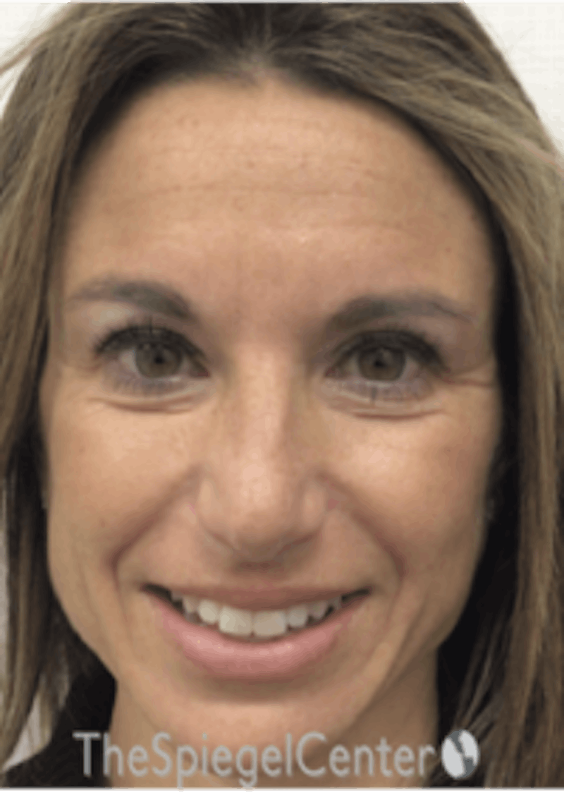 Botox / Dysport / Jeuveau / Xeomin Before & After Gallery - Patient 489094 - Image 5