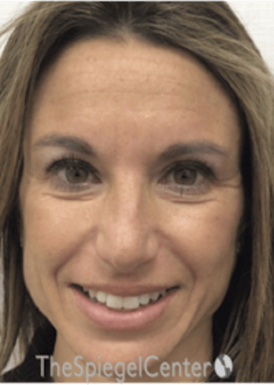 Botox / Dysport / Jeuveau / Xeomin Before & After Gallery - Patient 489094 - Image 5