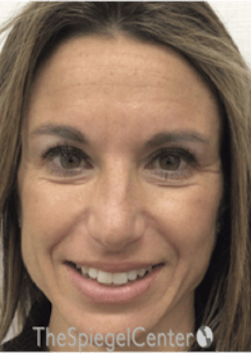 Botox / Dysport / Jeuveau / Xeomin Before & After Gallery - Patient 489094 - Image 5