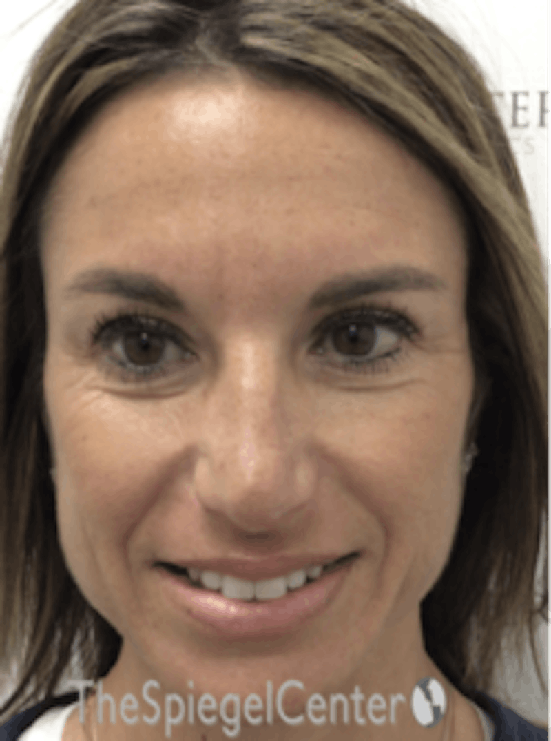Botox / Dysport / Jeuveau / Xeomin Before & After Gallery - Patient 489094 - Image 6