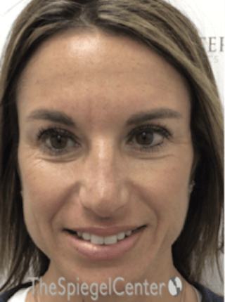 Botox / Dysport / Jeuveau / Xeomin Before & After Gallery - Patient 489094 - Image 6