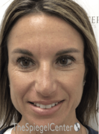 Botox / Dysport / Jeuveau / Xeomin Before & After Gallery - Patient 489094 - Image 6
