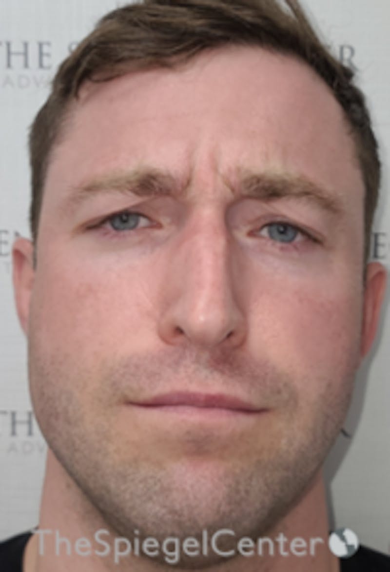 Botox / Dysport / Jeuveau / Xeomin Before & After Gallery - Patient 358554 - Image 1