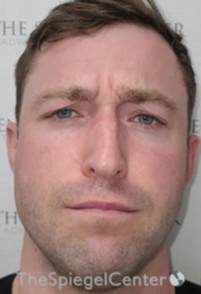 Botox / Dysport / Jeuveau / Xeomin Before & After Gallery - Patient 358554 - Image 1