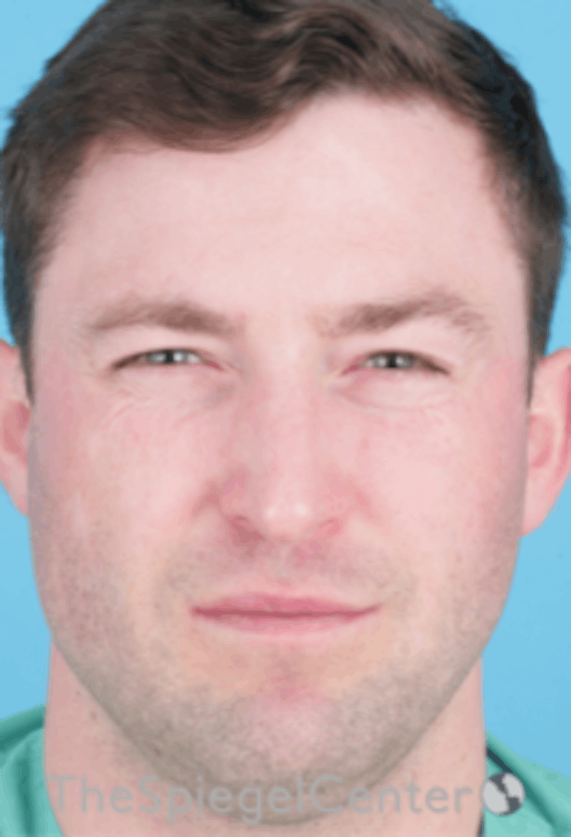 Botox / Dysport / Jeuveau / Xeomin Before & After Gallery - Patient 358554 - Image 2