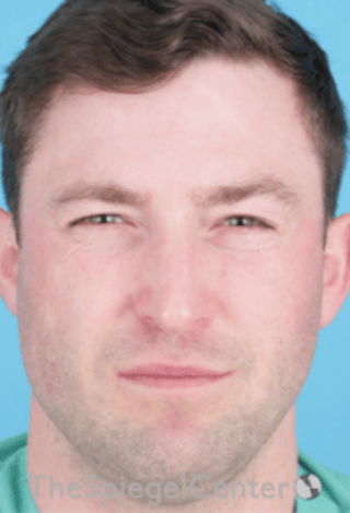 Botox / Dysport / Jeuveau / Xeomin Before & After Gallery - Patient 358554 - Image 2