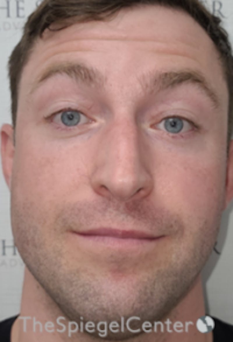 Botox / Dysport / Jeuveau / Xeomin Before & After Gallery - Patient 358554 - Image 3