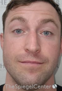 Botox / Dysport / Jeuveau / Xeomin Before & After Gallery - Patient 358554 - Image 3