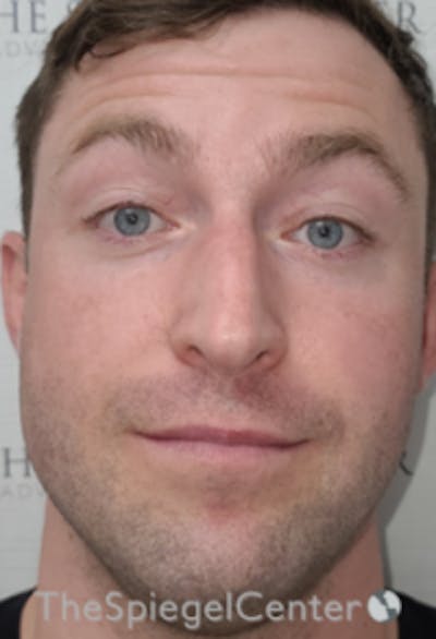 Botox / Dysport / Jeuveau / Xeomin Before & After Gallery - Patient 358554 - Image 3