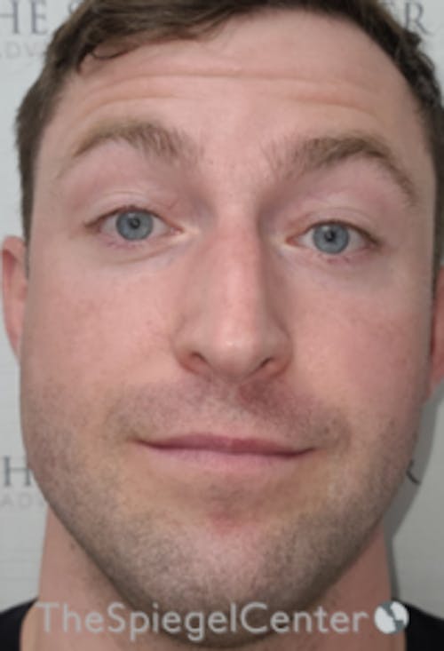 Botox / Dysport / Jeuveau / Xeomin Before & After Gallery - Patient 358554 - Image 3
