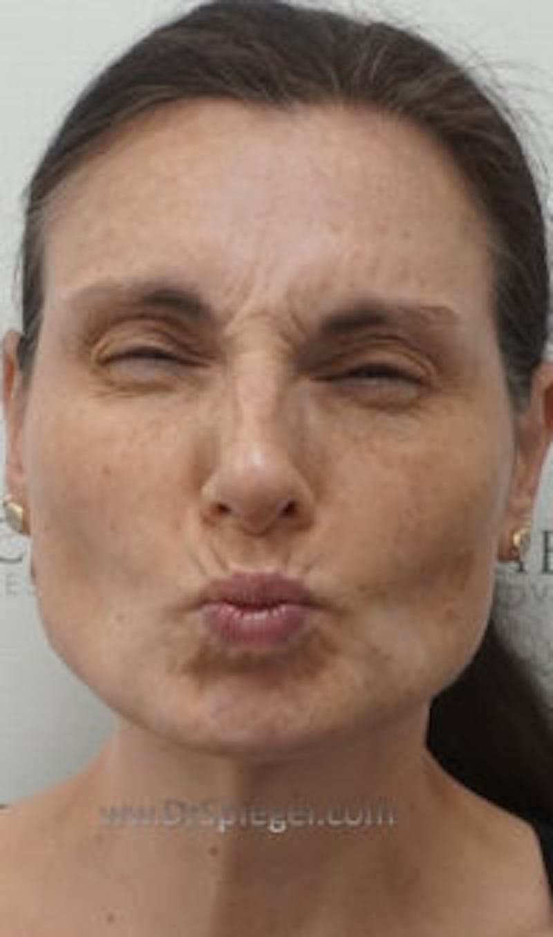 Botox / Dysport / Jeuveau / Xeomin Before & After Gallery - Patient 401192 - Image 1