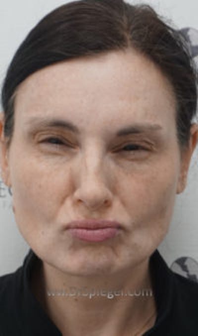 Botox / Dysport / Jeuveau / Xeomin Before & After Gallery - Patient 401192 - Image 2