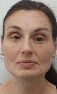 Botox / Dysport / Jeuveau / Xeomin Before & After Gallery - Patient 401192 - Image 3