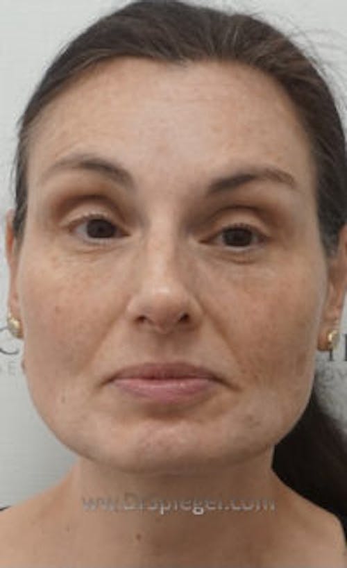 IPL / Intense Pulse Light Before & After Gallery - Patient 388895 - Image 1