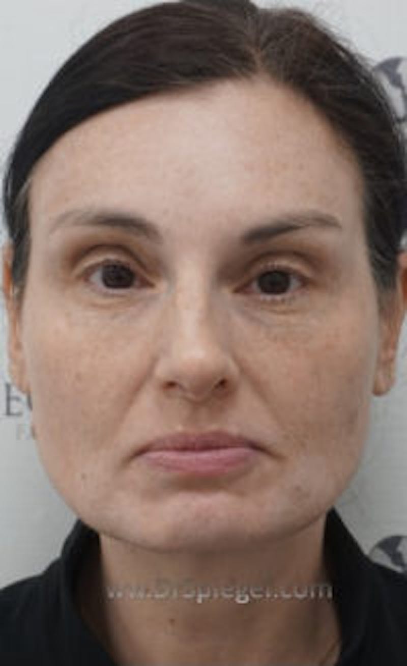 IPL / Intense Pulse Light Before & After Gallery - Patient 388895 - Image 2