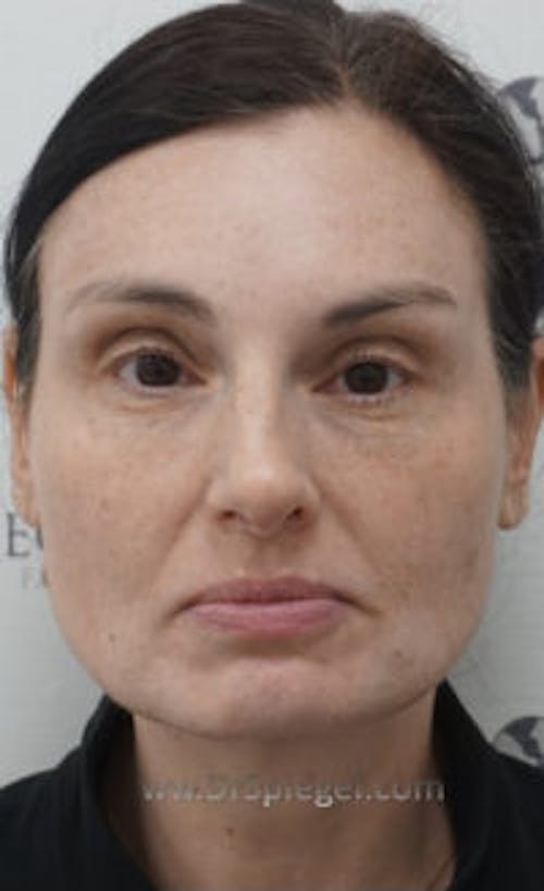 IPL / Intense Pulse Light Before & After Gallery - Patient 388895 - Image 2