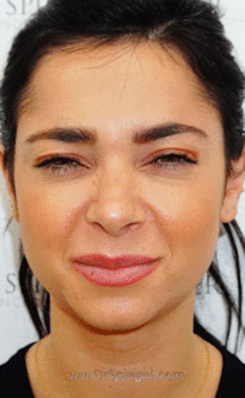 Botox / Dysport / Jeuveau / Xeomin Before & After Gallery - Patient 416771 - Image 2