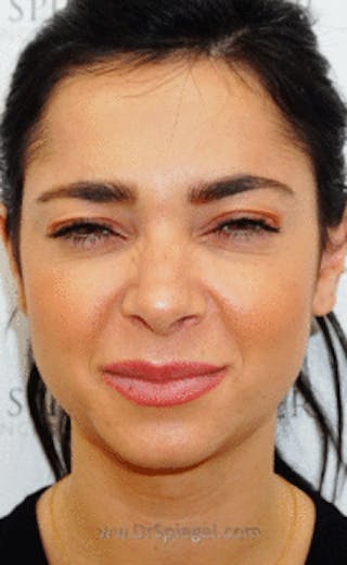 Botox / Dysport / Jeuveau / Xeomin Before & After Gallery - Patient 416771 - Image 2