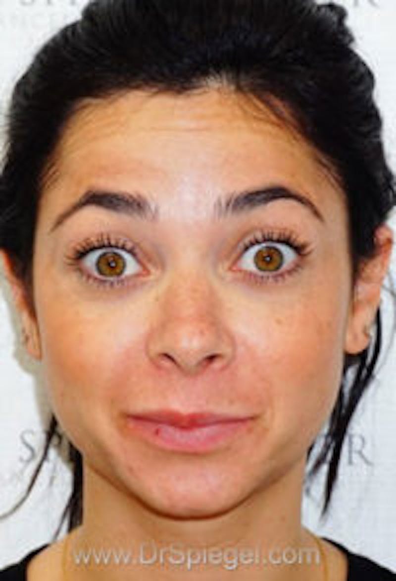 Botox / Dysport / Jeuveau / Xeomin Before & After Gallery - Patient 416771 - Image 3