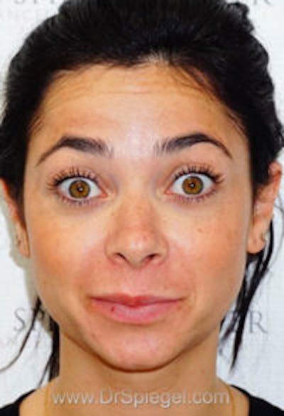 Botox / Dysport / Jeuveau / Xeomin Before & After Gallery - Patient 416771 - Image 3