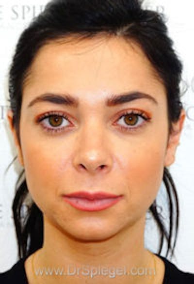 Botox / Dysport / Jeuveau / Xeomin Before & After Gallery - Patient 416771 - Image 4