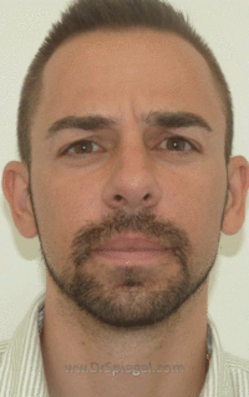 Botox / Dysport / Jeuveau / Xeomin Before & After Gallery - Patient 269221 - Image 1