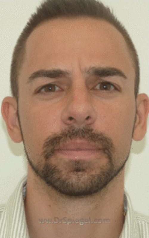 Botox / Dysport / Jeuveau / Xeomin Before & After Gallery - Patient 269221 - Image 1