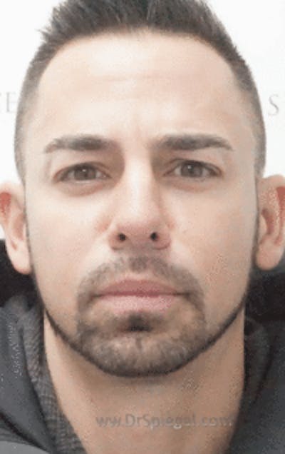 Botox / Dysport / Jeuveau / Xeomin Before & After Gallery - Patient 269221 - Image 2