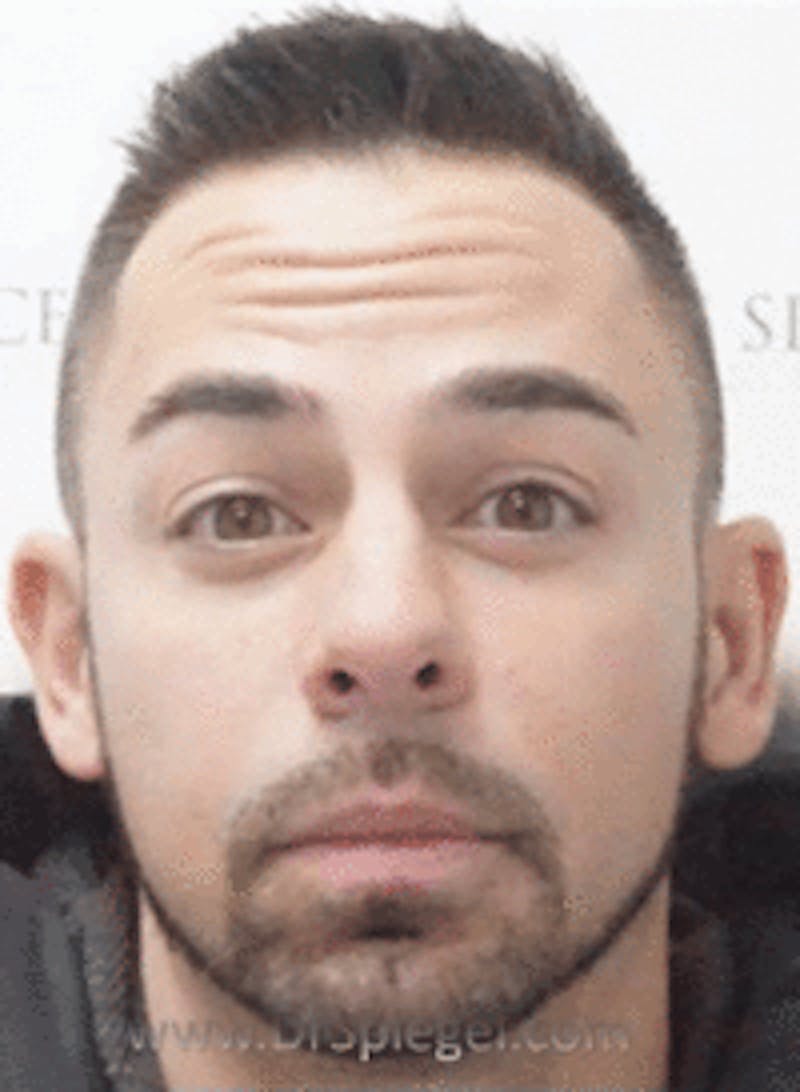 Botox / Dysport / Jeuveau / Xeomin Before & After Gallery - Patient 269221 - Image 3