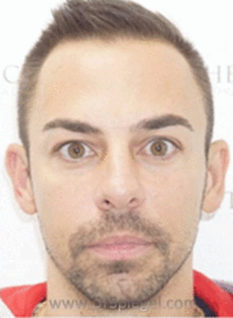 Botox / Dysport / Jeuveau / Xeomin Before & After Gallery - Patient 269221 - Image 4