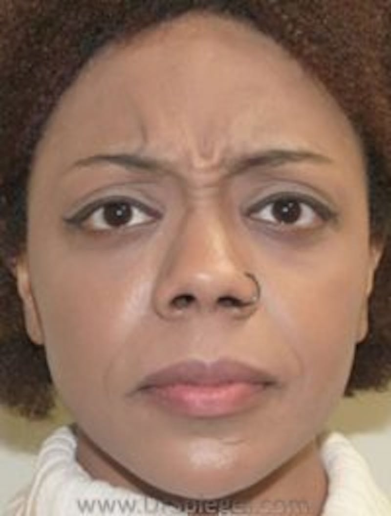 Botox / Dysport / Jeuveau / Xeomin Before & After Gallery - Patient 268036 - Image 1