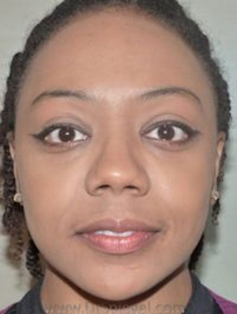 Botox / Dysport / Jeuveau / Xeomin Before & After Gallery - Patient 268036 - Image 2