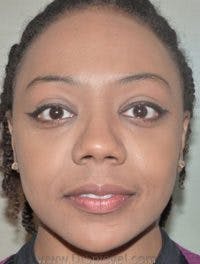 Botox / Dysport / Jeuveau / Xeomin Before & After Gallery - Patient 268036 - Image 2