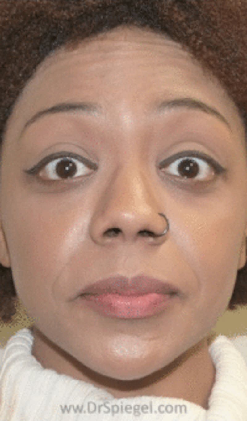 Botox / Dysport / Jeuveau / Xeomin Before & After Gallery - Patient 268036 - Image 3