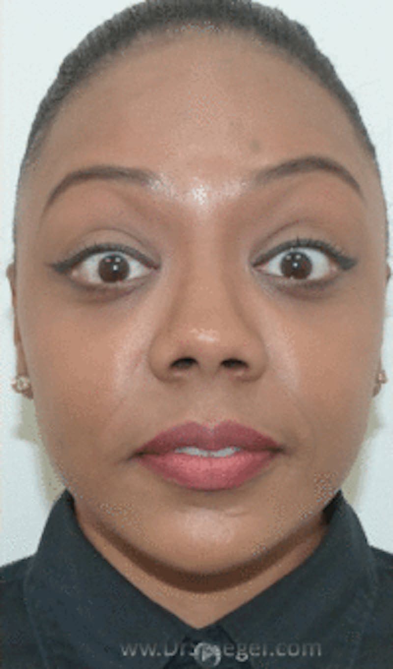 Botox / Dysport / Jeuveau / Xeomin Before & After Gallery - Patient 268036 - Image 4