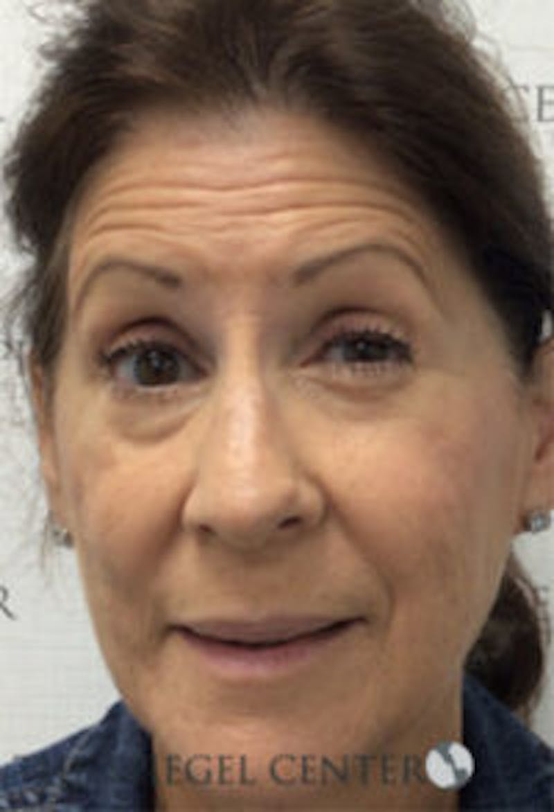 Botox / Dysport / Jeuveau / Xeomin Before & After Gallery - Patient 354974 - Image 3
