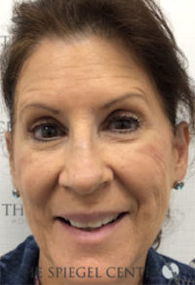Botox / Dysport / Jeuveau / Xeomin Before & After Gallery - Patient 354974 - Image 4
