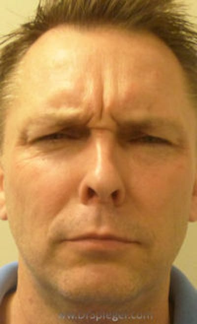 Botox / Dysport / Jeuveau / Xeomin Before & After Gallery - Patient 147012 - Image 1