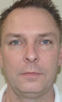 Botox / Dysport / Jeuveau / Xeomin Before & After Gallery - Patient 147012 - Image 2