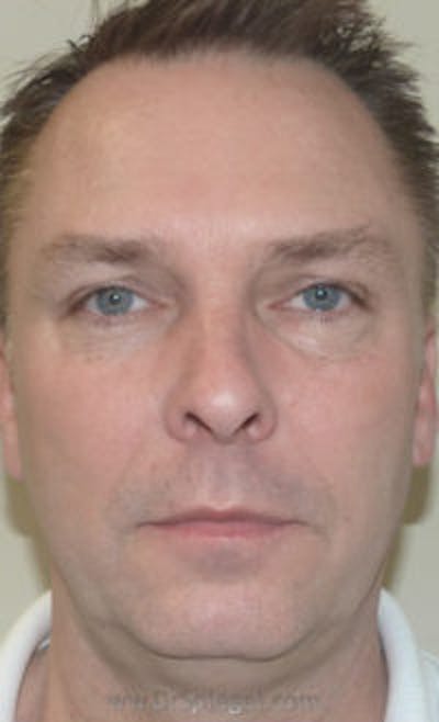 Botox / Dysport / Jeuveau / Xeomin Before & After Gallery - Patient 147012 - Image 2