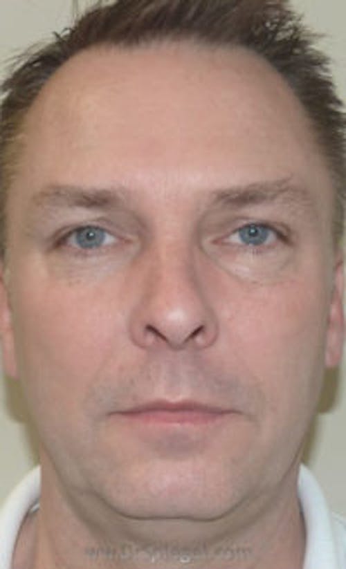 Botox / Dysport / Jeuveau / Xeomin Before & After Gallery - Patient 147012 - Image 2