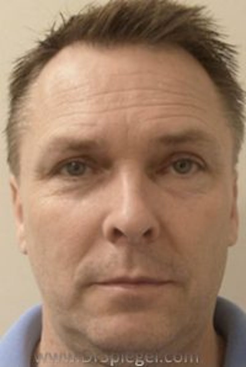 Botox / Dysport / Jeuveau / Xeomin Before & After Gallery - Patient 147012 - Image 3