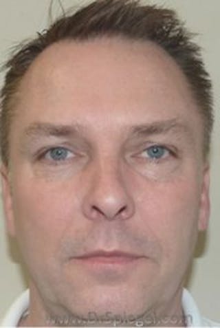 Botox / Dysport / Jeuveau / Xeomin Before & After Gallery - Patient 147012 - Image 4